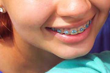 Soñar con Brackets