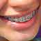 Sueños con Brackets